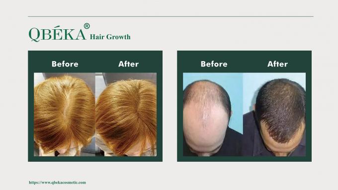 80 ml al giorno di GMPC Trattamento standard per la perdita di capelli maschile eccessiva e il ritiro della linea dei capelli 10