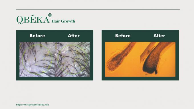 80 ml al giorno di GMPC Trattamento standard per la perdita di capelli maschile eccessiva e il ritiro della linea dei capelli 11