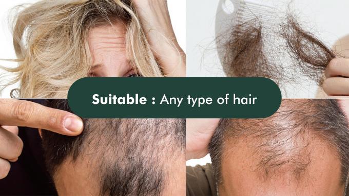 80 ml al giorno di GMPC Trattamento standard per la perdita di capelli maschile eccessiva e il ritiro della linea dei capelli 12
