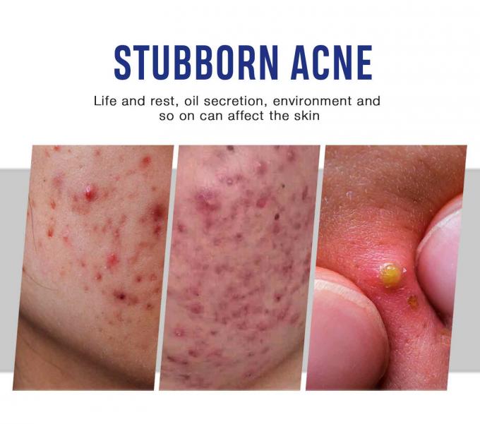 Crema naturale organica per il trattamento dell' acne quantità 1000 7