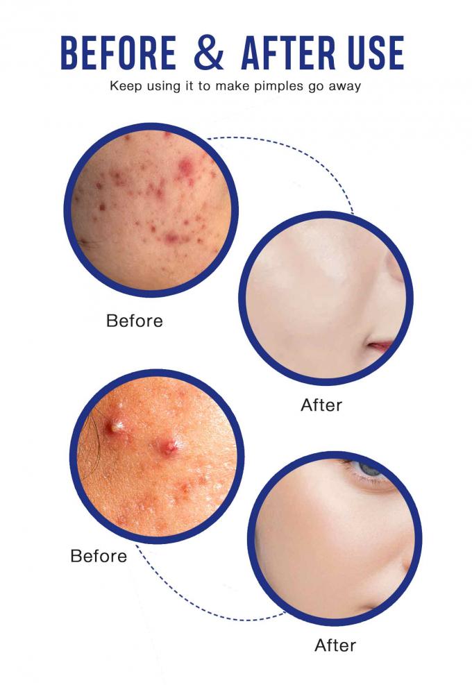 Crema naturale organica per il trattamento dell' acne quantità 1000 9