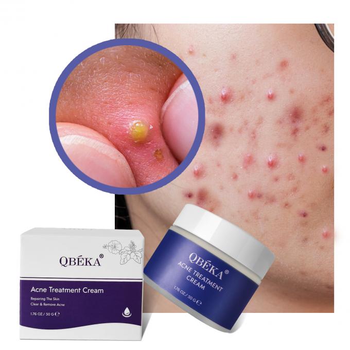 Crema efficace per il trattamento dell' acne del tè verde per le donne in blocco 1