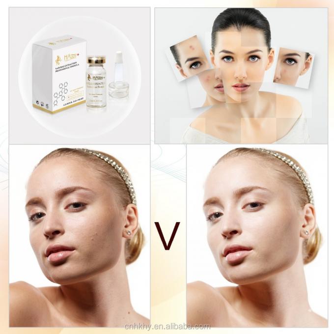 Rimuovi le cicatrici dell' acne con QBEKA Happy Cosmetics Levorotatory VC Original Liquid Bio Serum 0